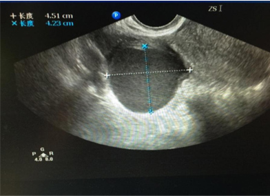 1523578705774576.jpg 巧克力囊肿.jpg